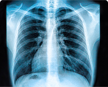 X-Ray
